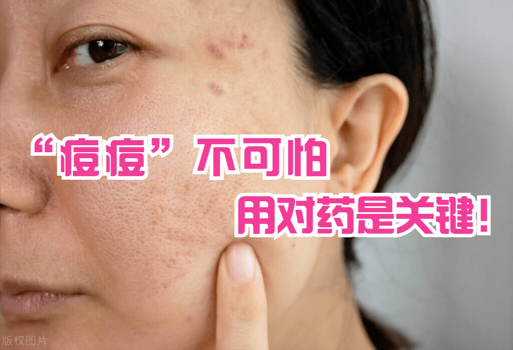 便宜又好的手机:脸上起痘痘，这个“小药膏”便宜又好用！